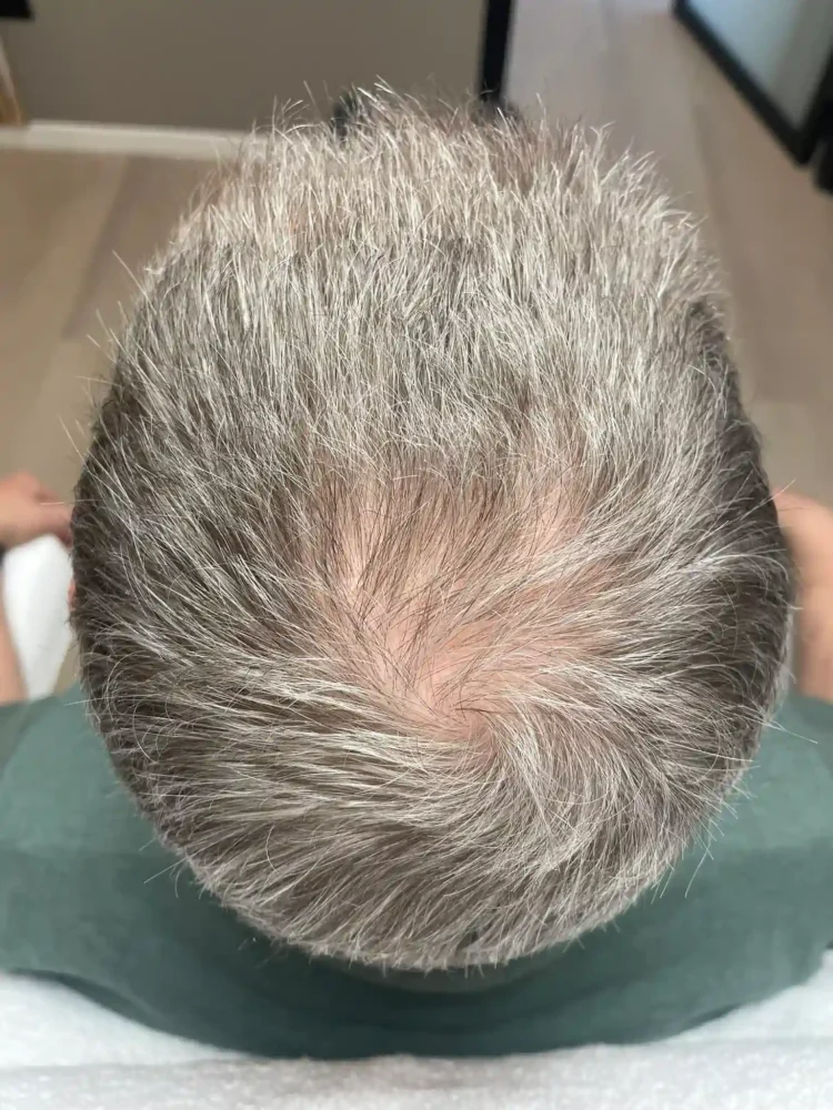 1e sessie (vóór behandeling)