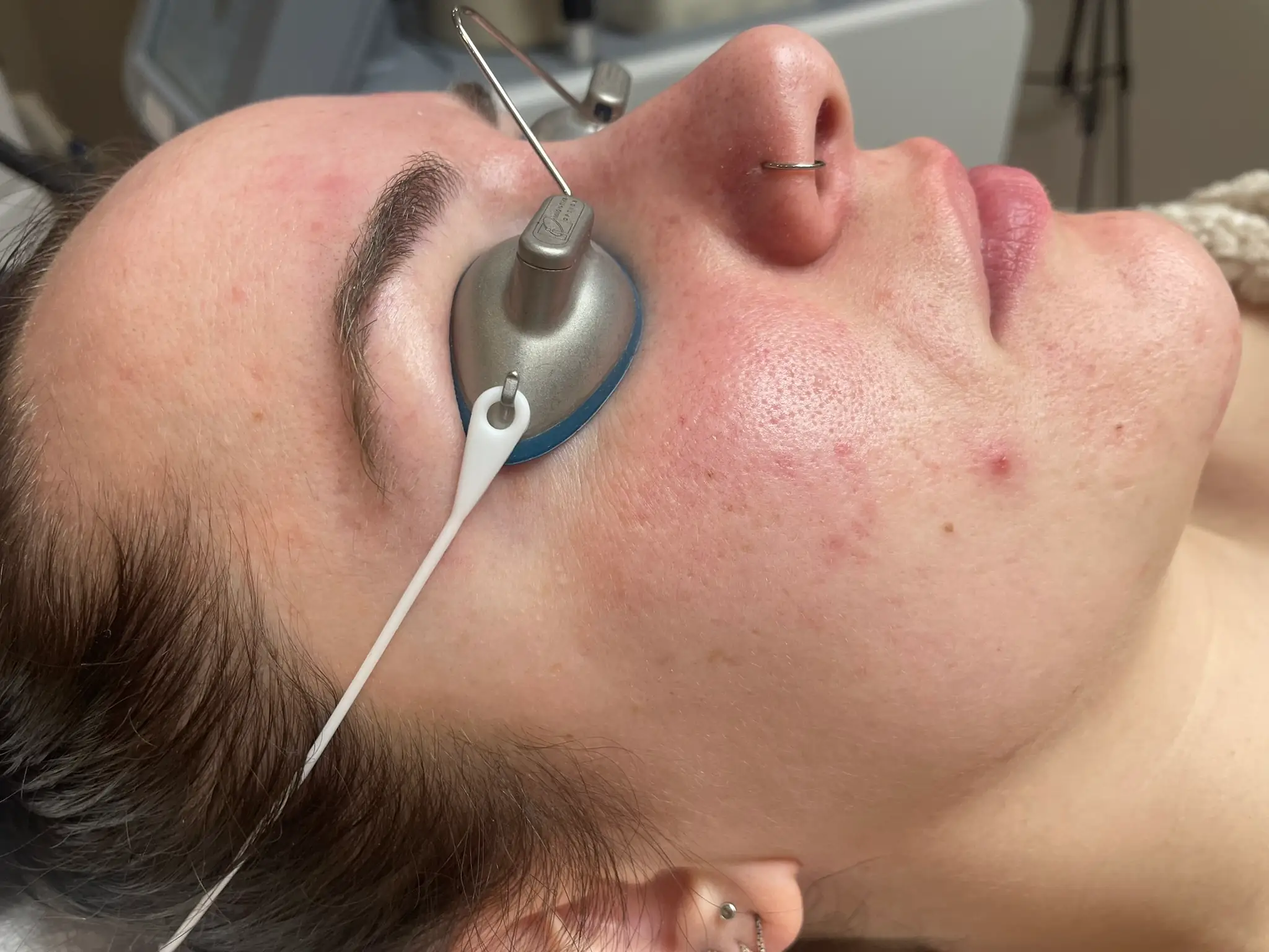 Acne laser behandeling resultaat ( na 3 sessies)