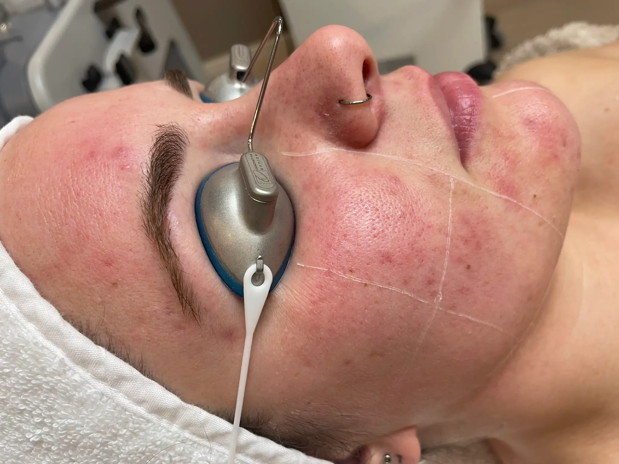 Acne laser behandeling resultaat (na eerste sessie)