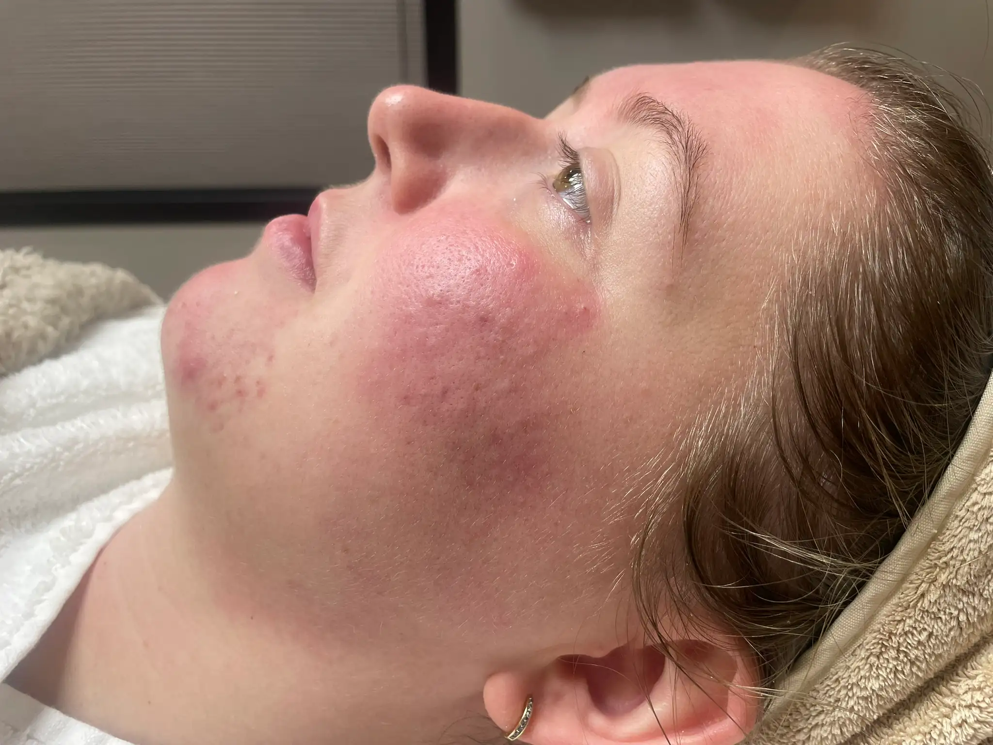 Acne resultaat chemische peeling (1) na