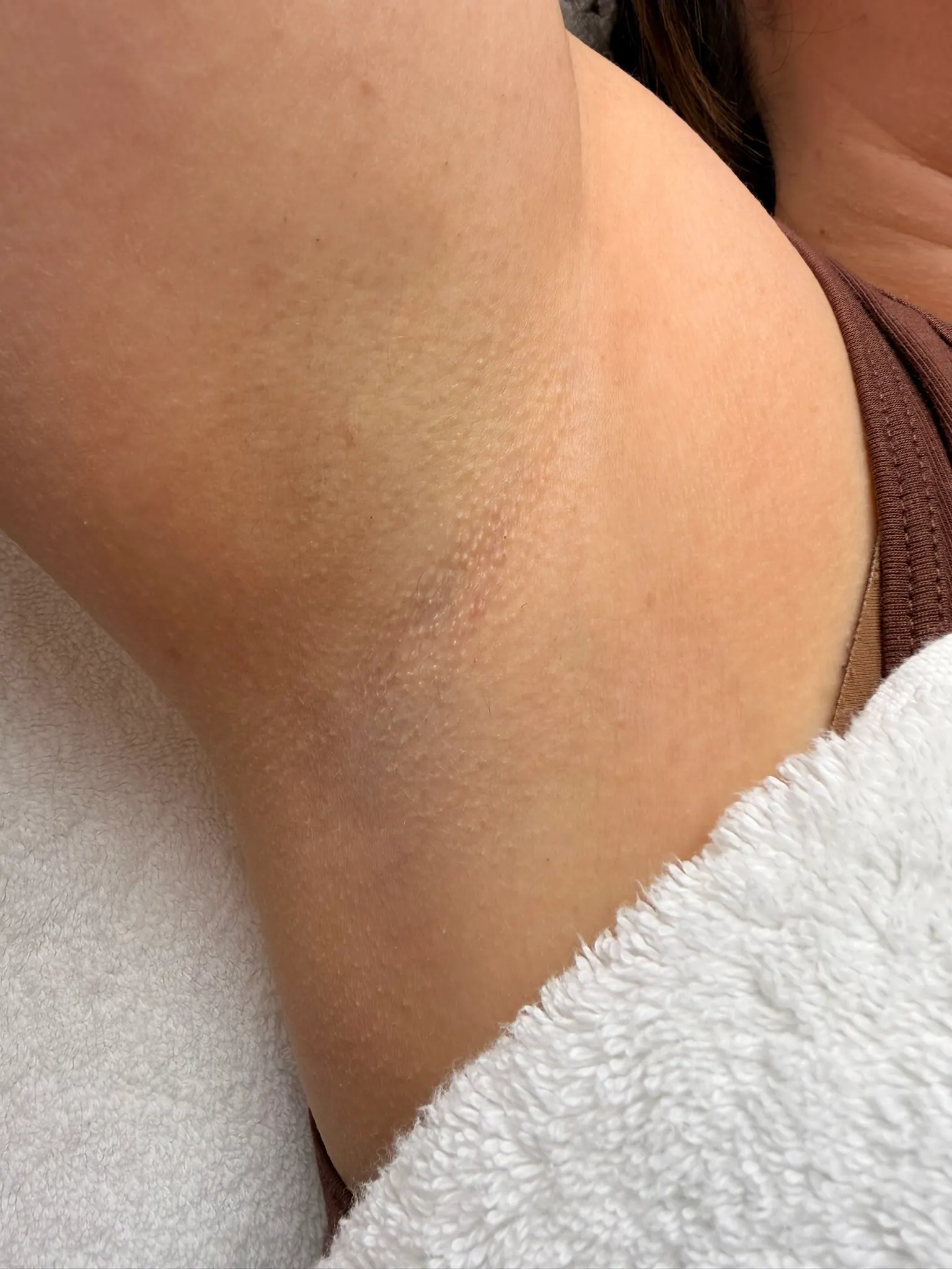 Laserontharing oksel -na foto (1) (1)