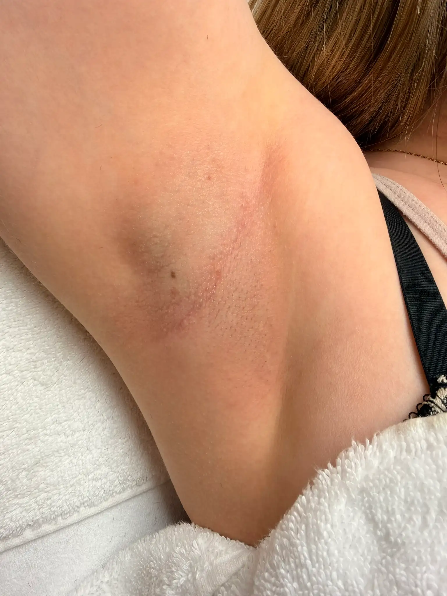 Laserontharing oksel - na foto (2)