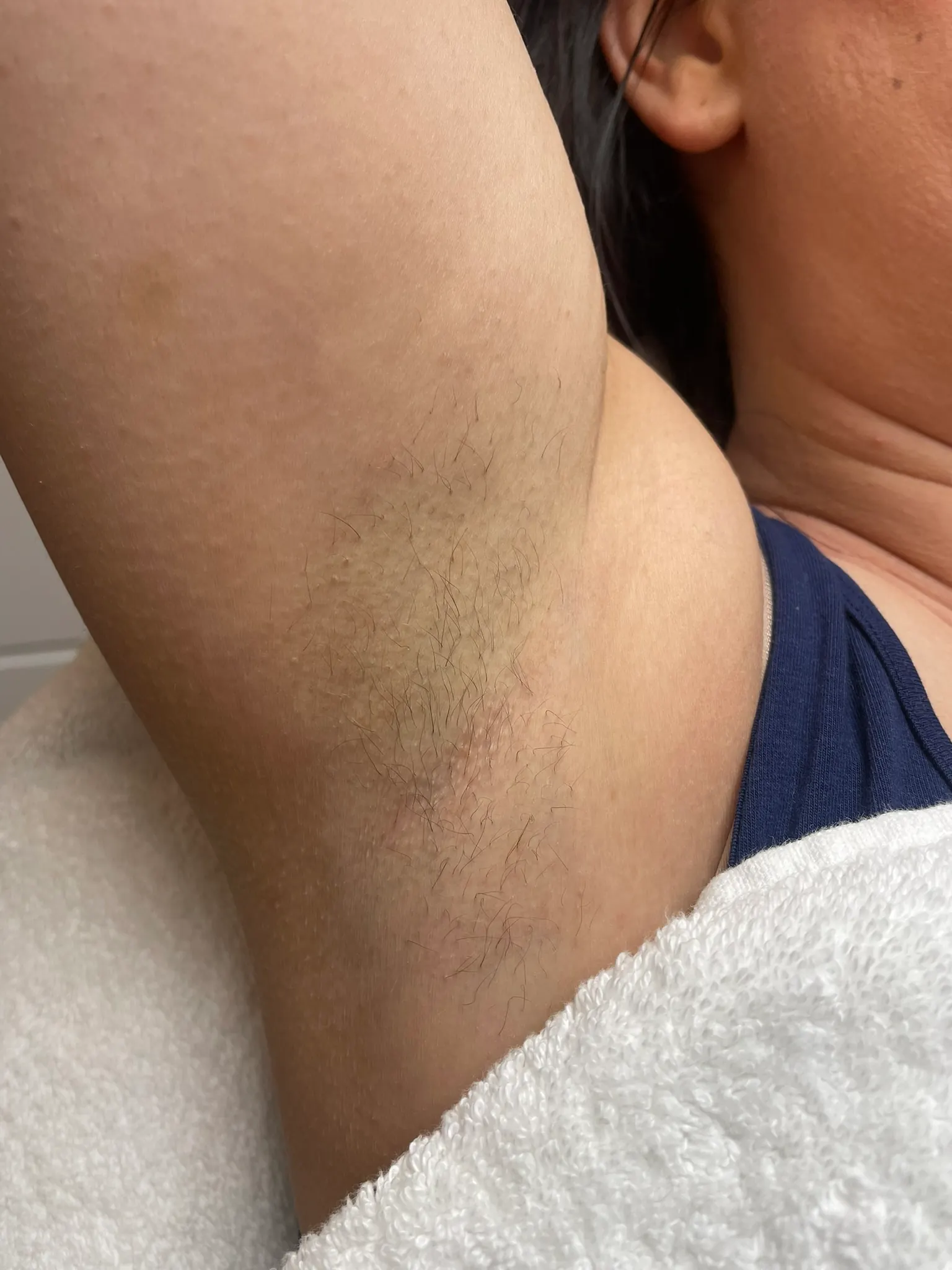 Laserontharing oksel - voor foto (1)