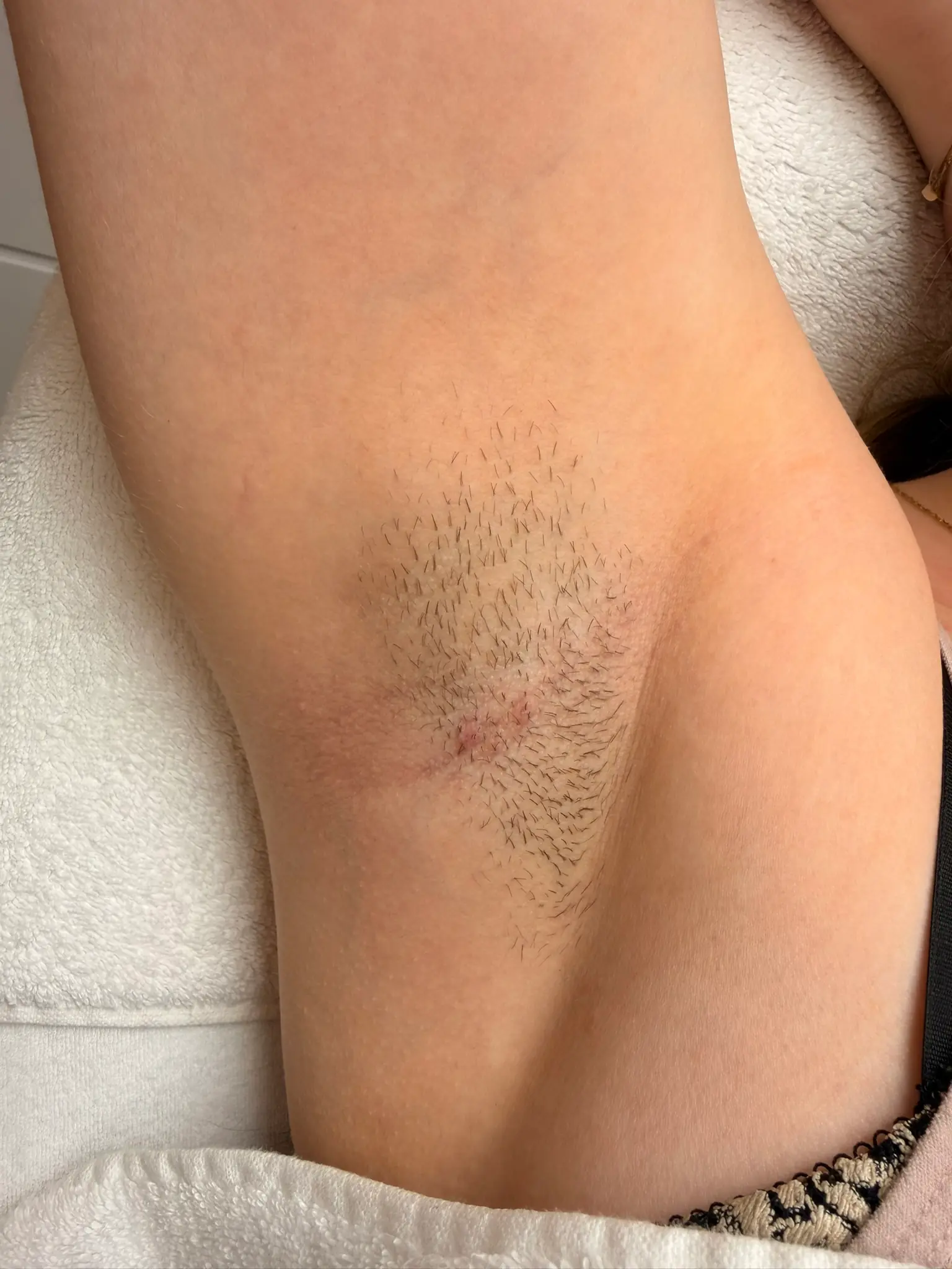 Laserontharing oksel - voor foto (2)