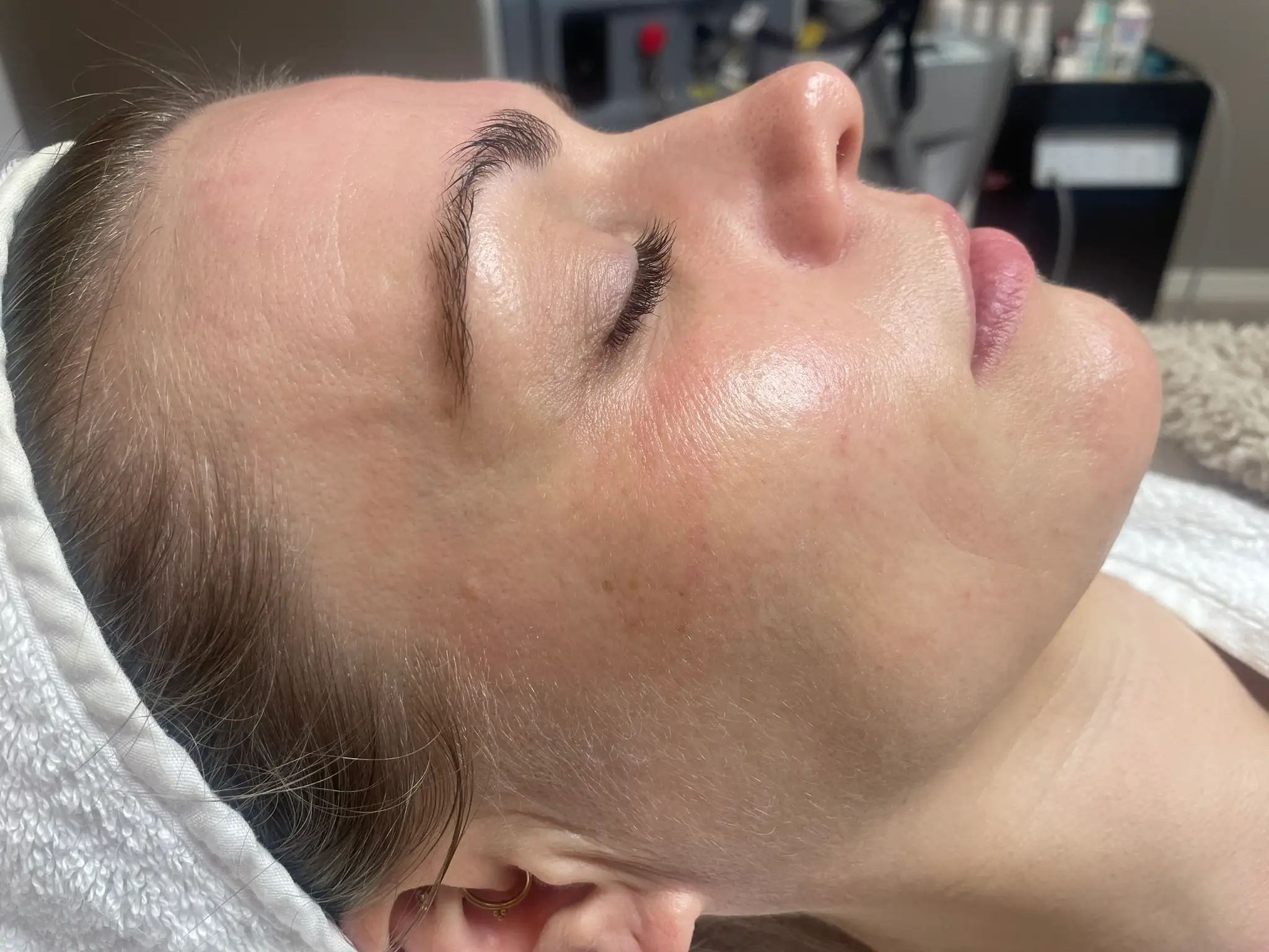 Resultaat doffe huid (na)