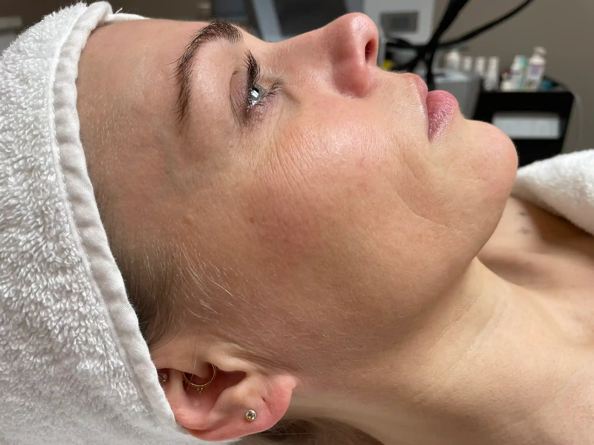 Resultaat doffe huid (voor)