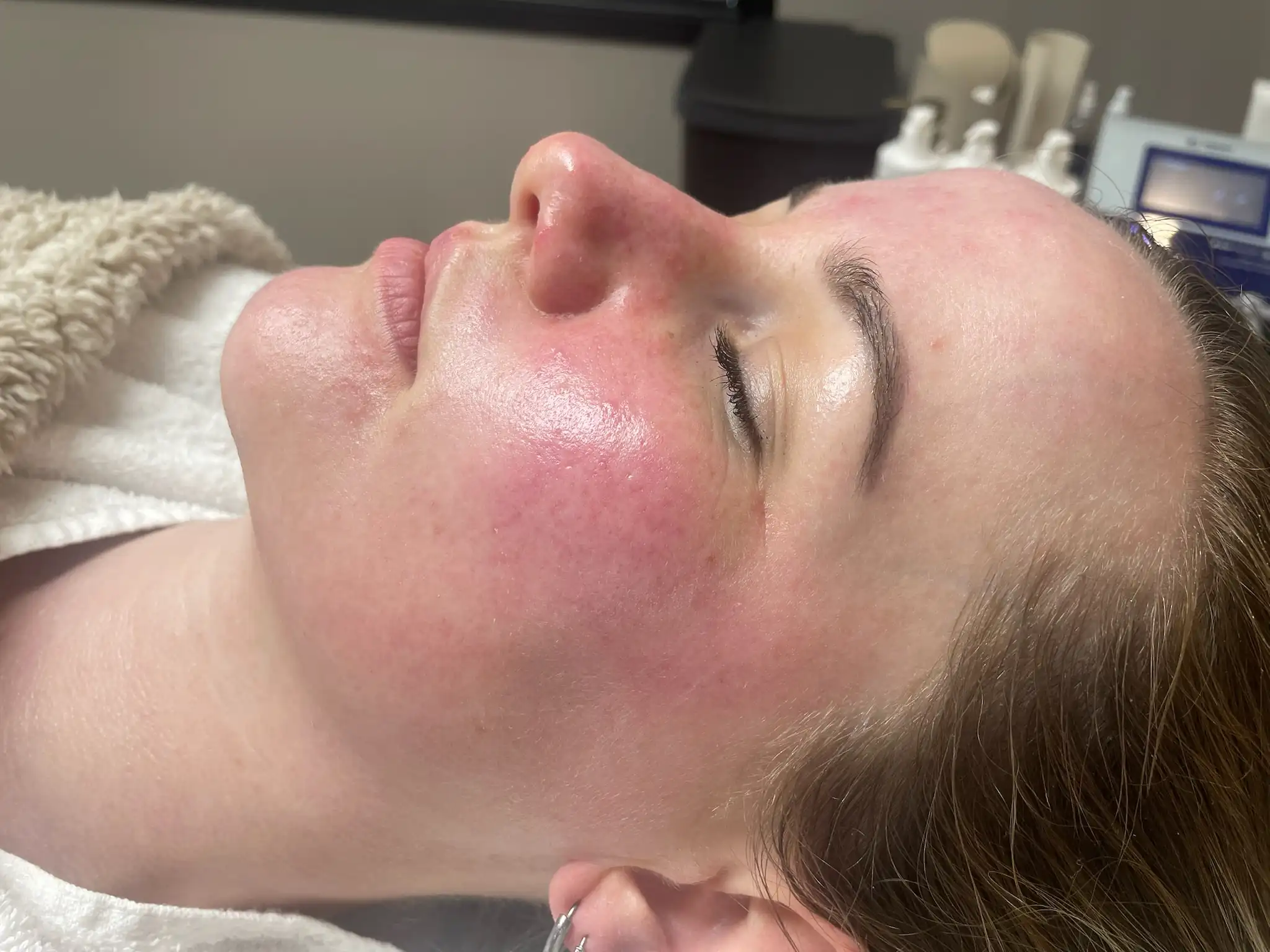 Resultaat gevoelige huid (na) (1)