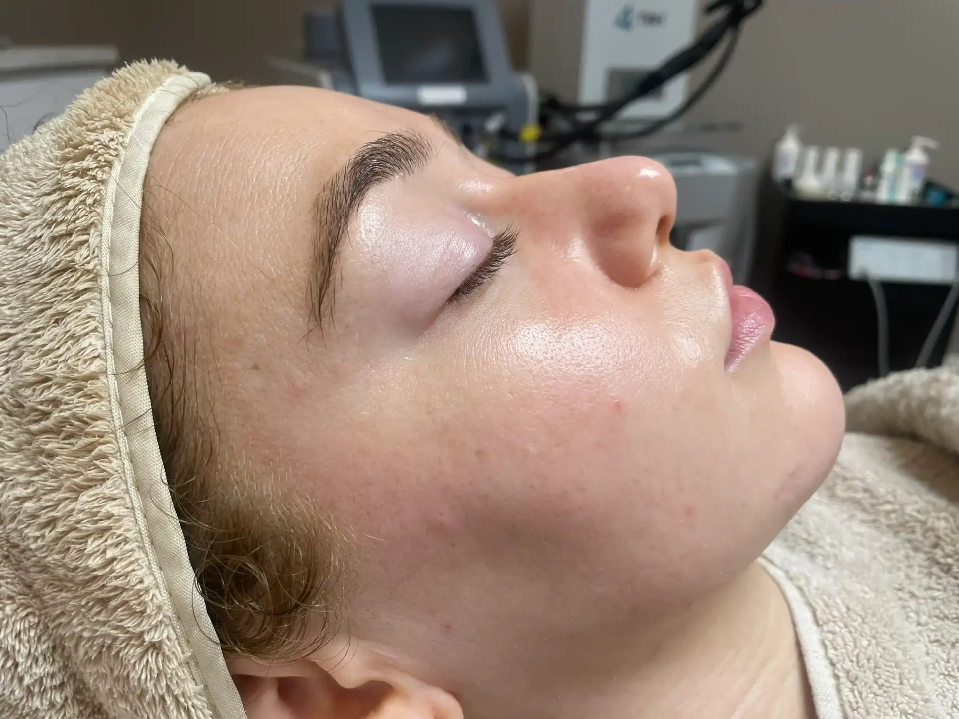 Resultaat grove poriën (na) 2