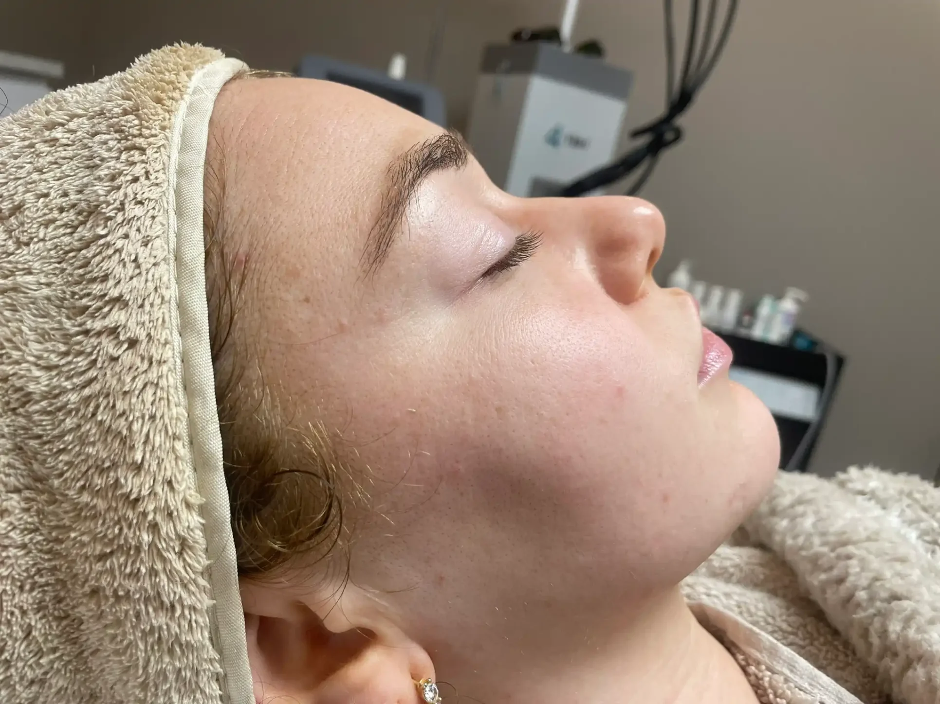 Resultaat grove poriën (voor) 2