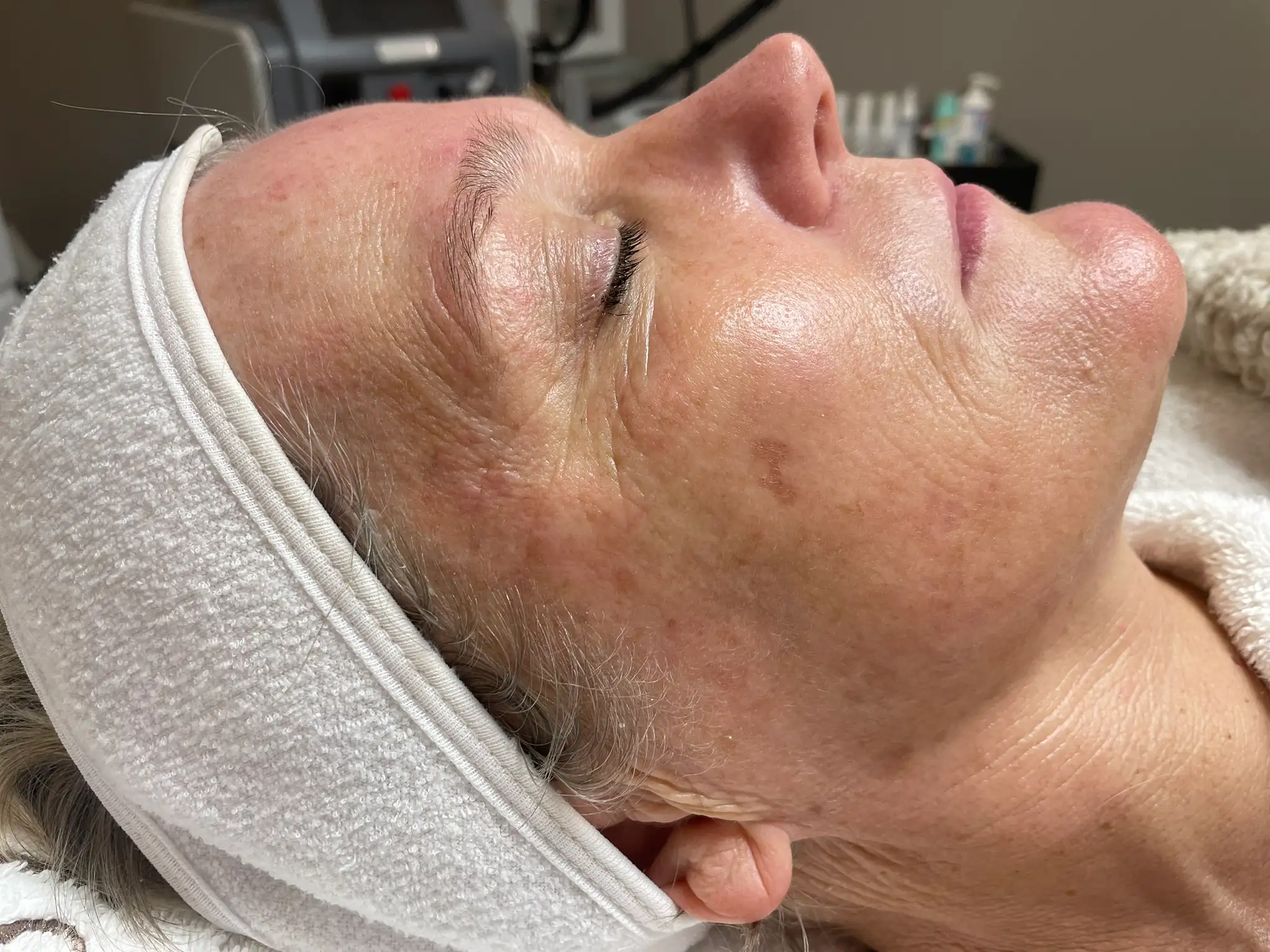 Resultaat huidverjoning mesotherapie (na)