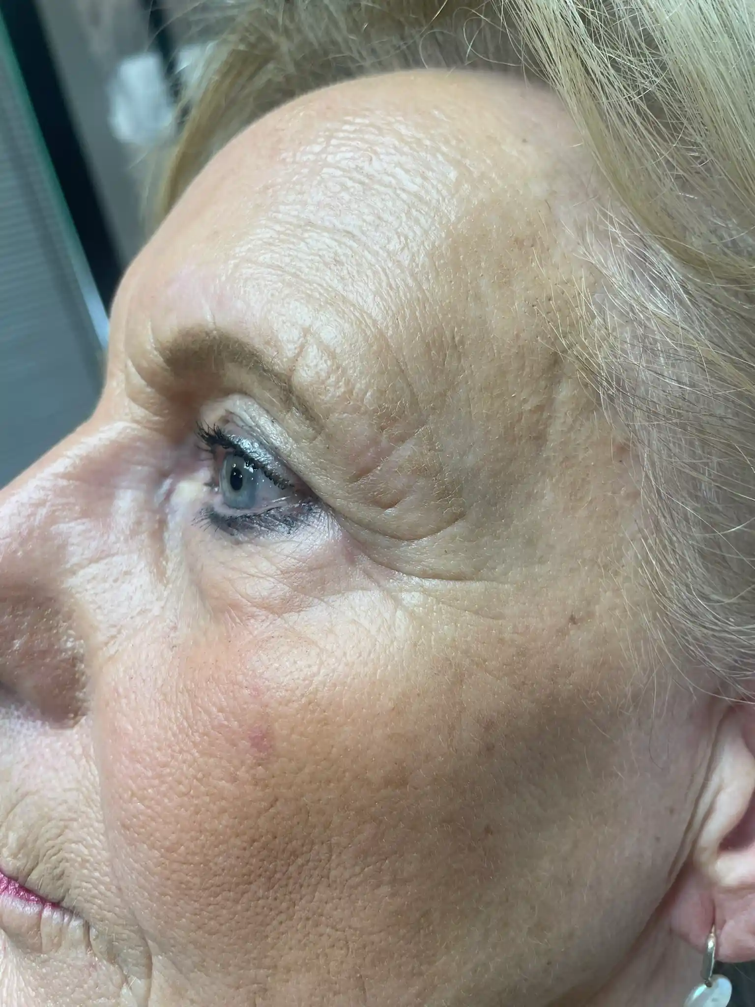 Resultaat pigment laser behandeling (na) (1)