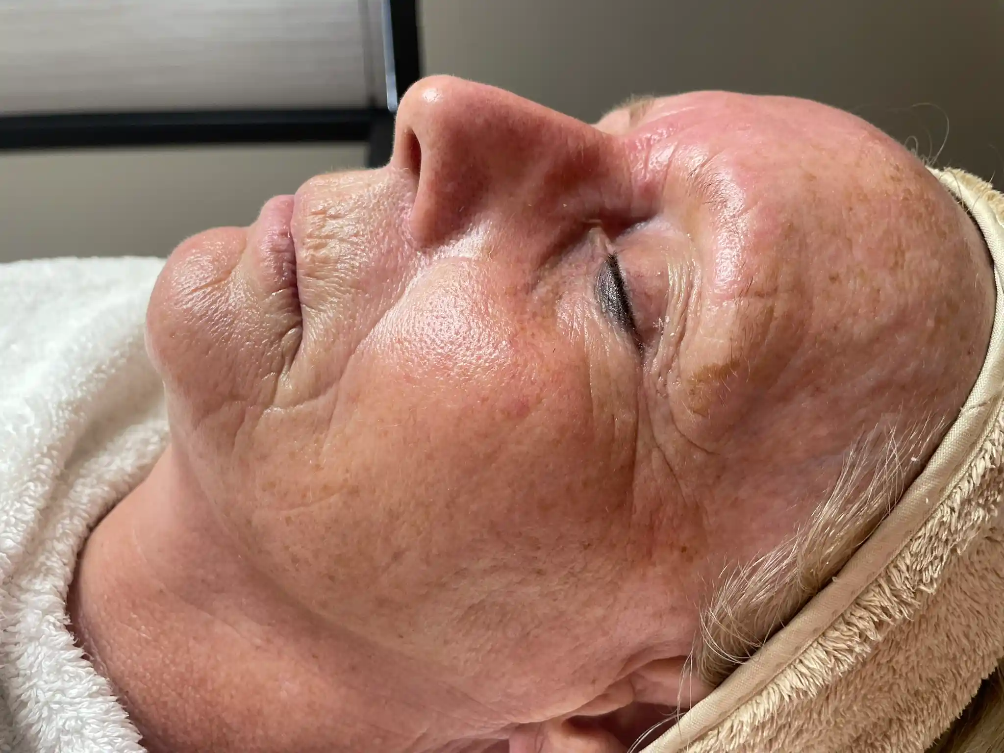 Resultaat pigment mesotherapie (na)