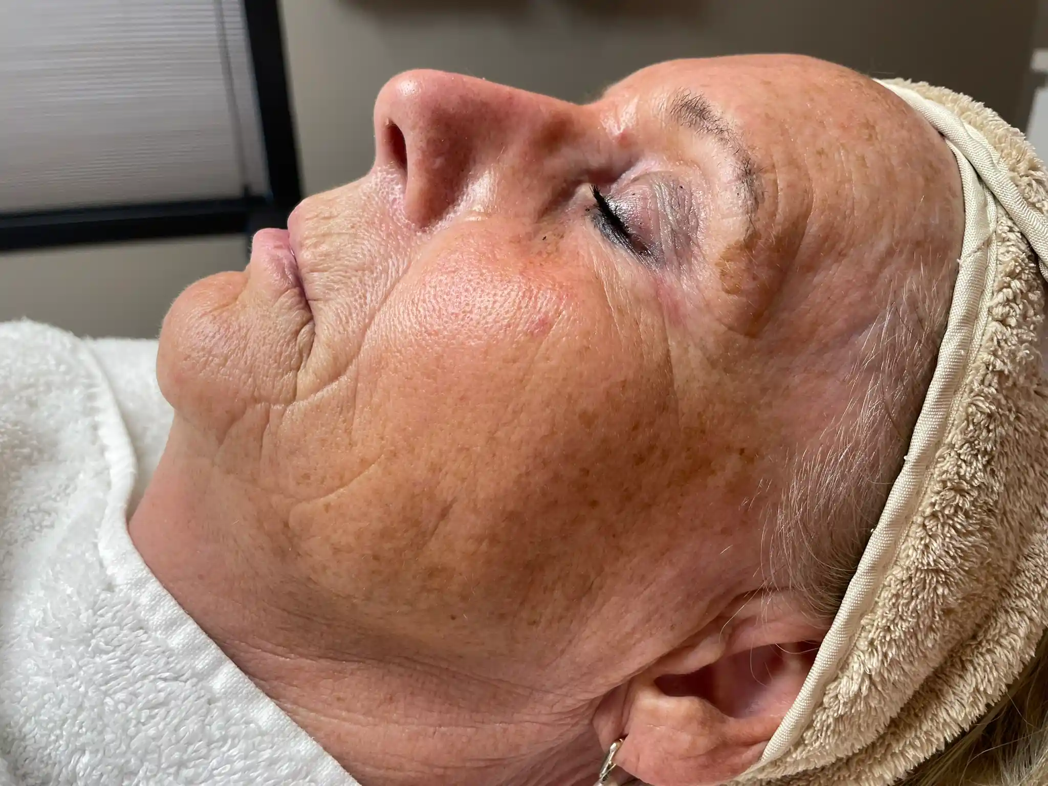 Resultaat pigment mesotherapie (voor)