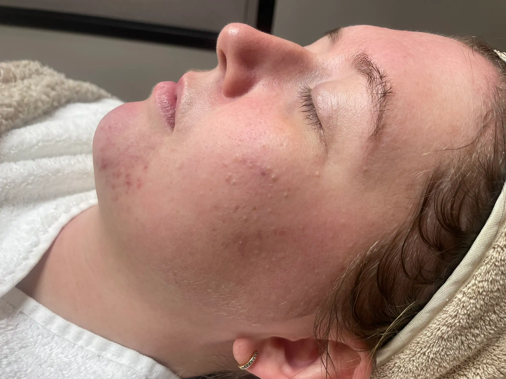 acne resultaat chemische peeling (1) voor