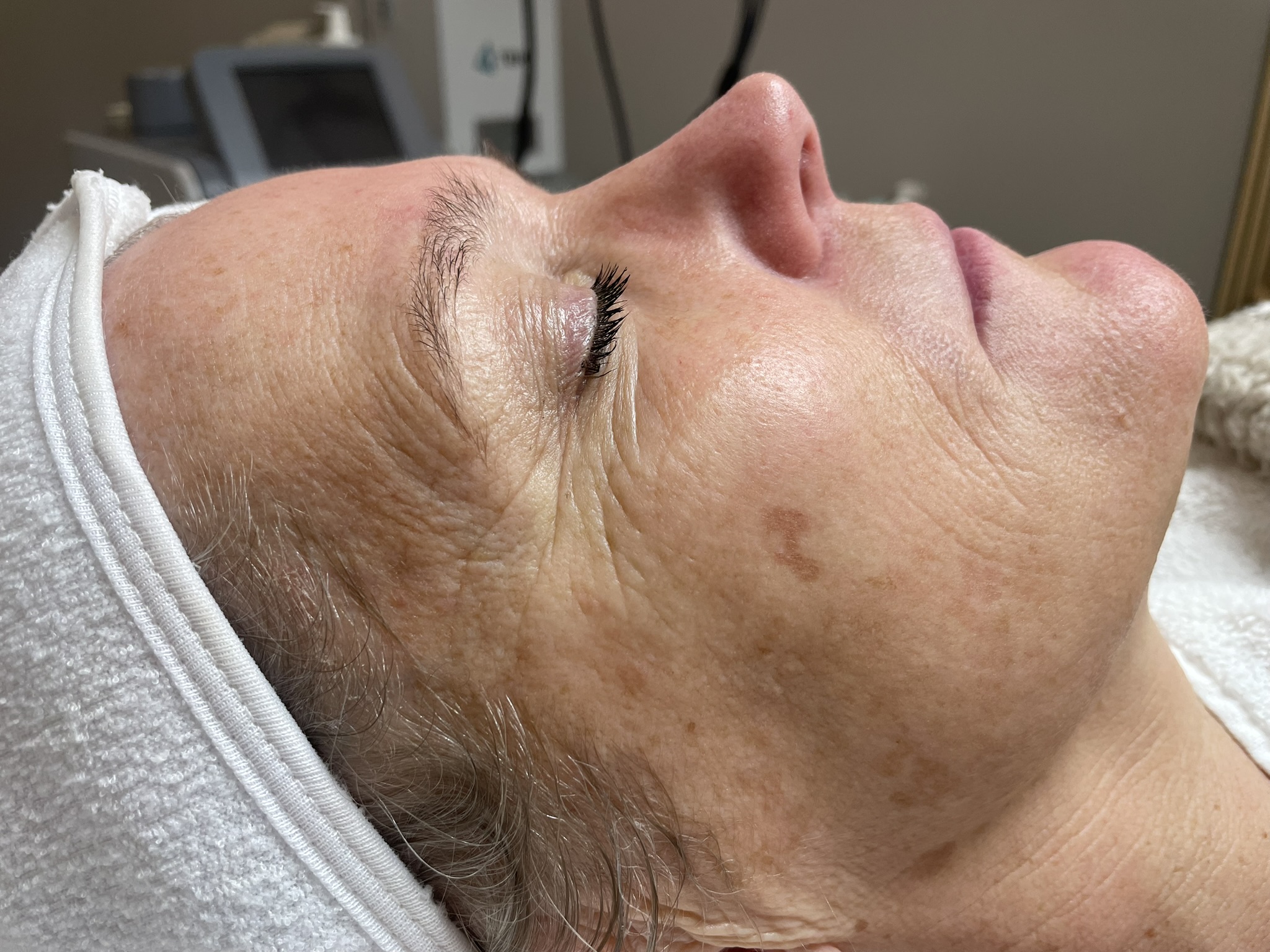 resultaat Huidverjonging mesotherapie (voor)