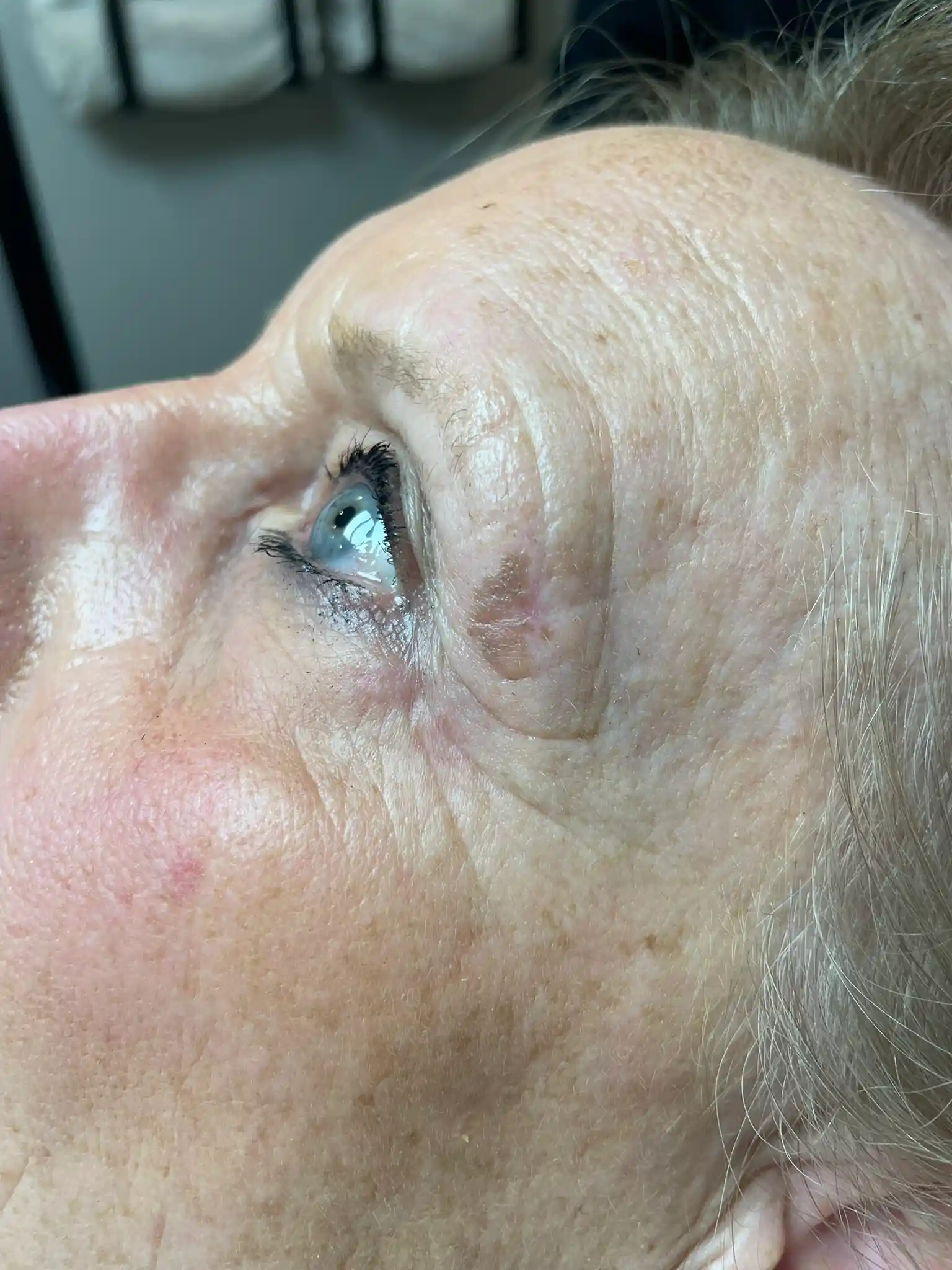 resultaat Pigment laser behandeling (voor)