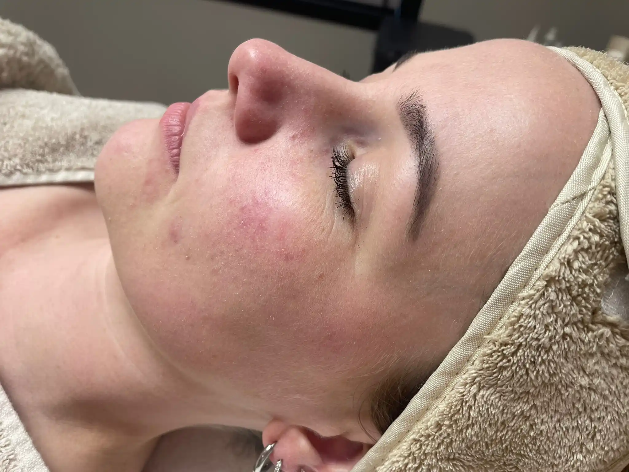 resultaat gevoelige huid (voor)